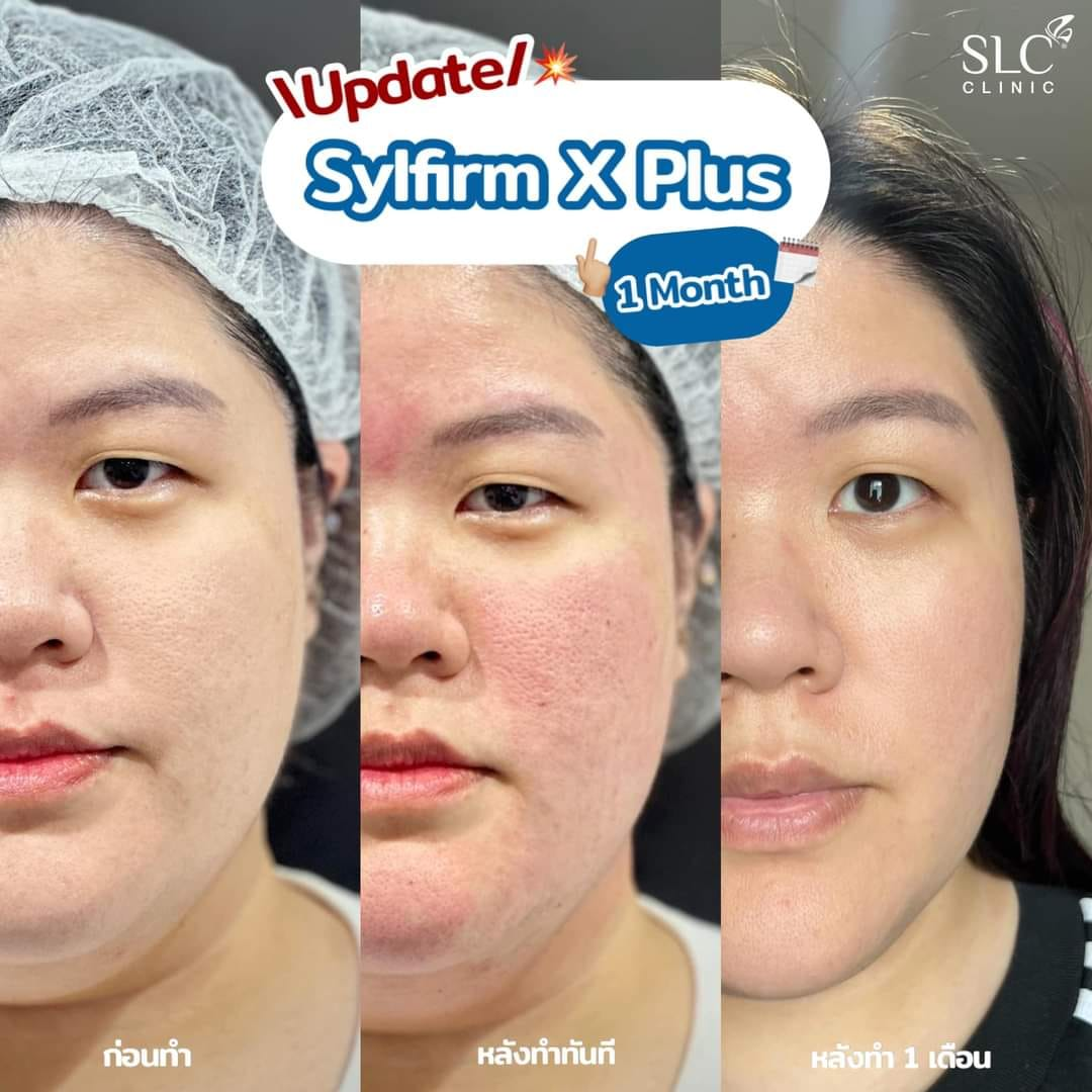 รักษาหลุมสิว, รอยสิว, Pico Plus Laser, Sylfirm X Plus