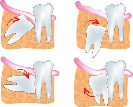 Richmond Hill tooth extraction services