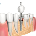 Nhiễm Khuẩn Răng Miệng: Hậu Quả, Phương Pháp Điều Trị