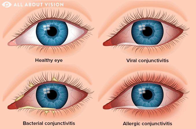 Types of Conjunctivitis (Pink Eye) - All About Vision