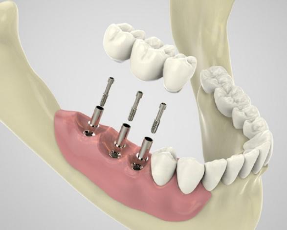 dental implants treatment in Burnaby