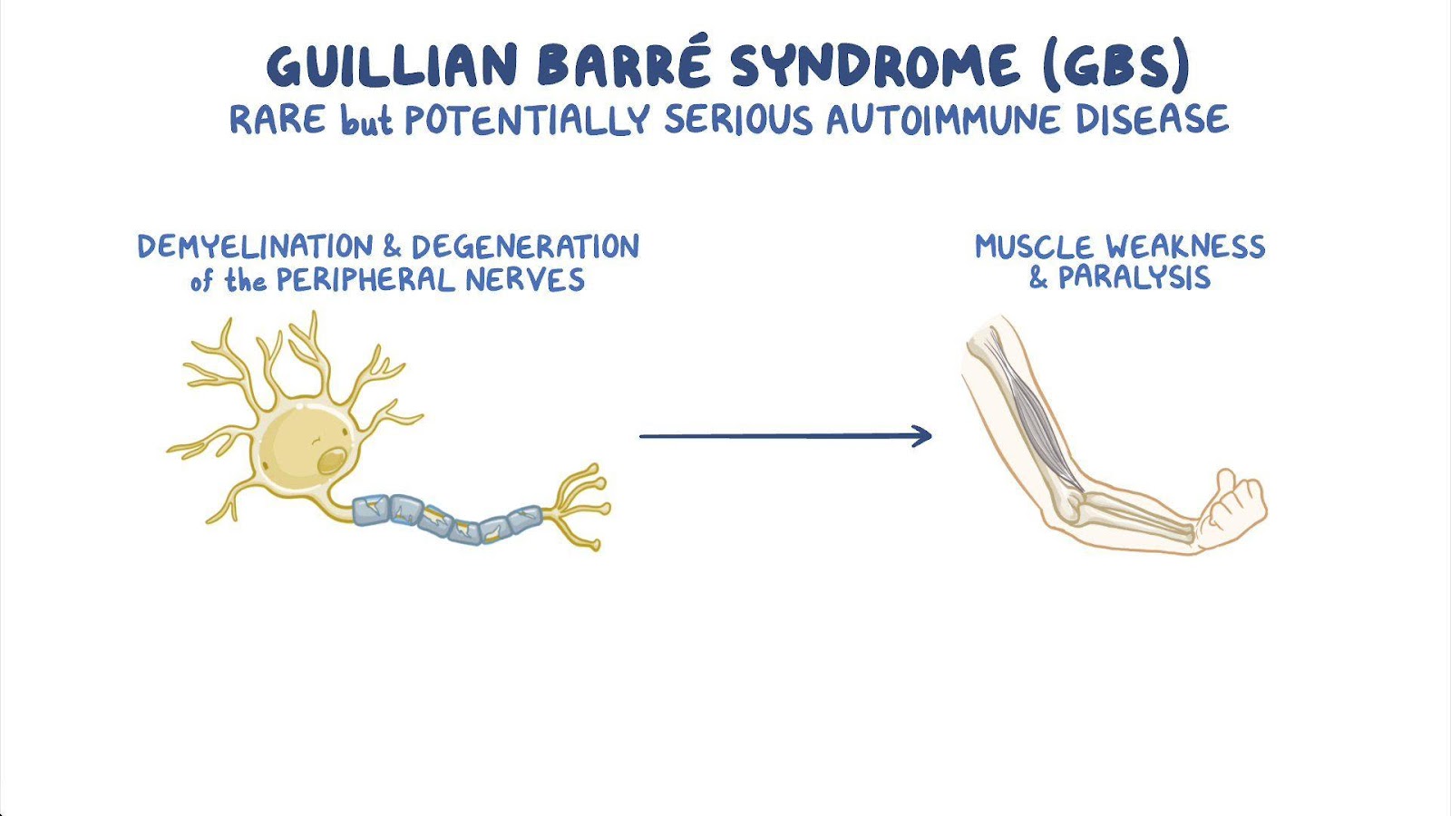 Guillain-Barré syndrome: Nursing - Osmosis Video Library