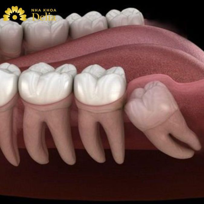 Mọc răng khôn khiến chân răng hàm dưới đau nhức khó chịu