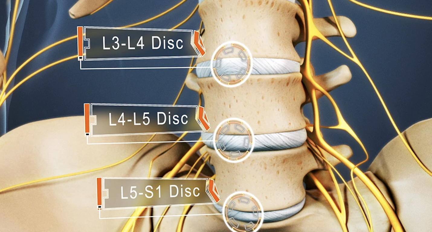 Lumbar-L5-S1-disc-herniation