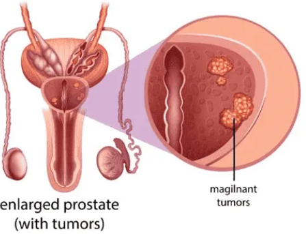 What Is Low PSA Metastatic Prostate Cancer?