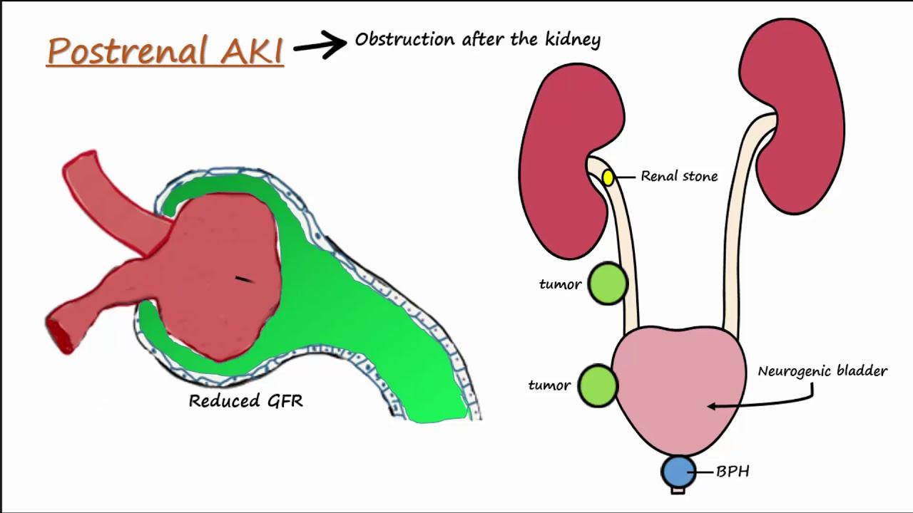 Acute Kidney Injury (AKI) - Prerenal,Intrarenal,Postrenal - YouTube