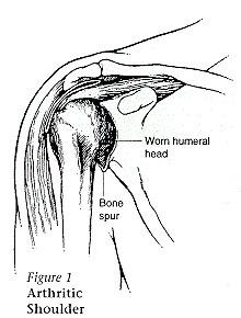 illustration of shoulder arthritis