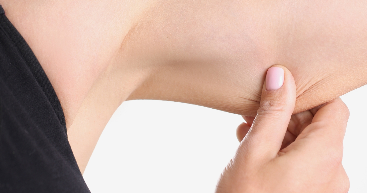 Does Arm Lipo Leave Loose Skin