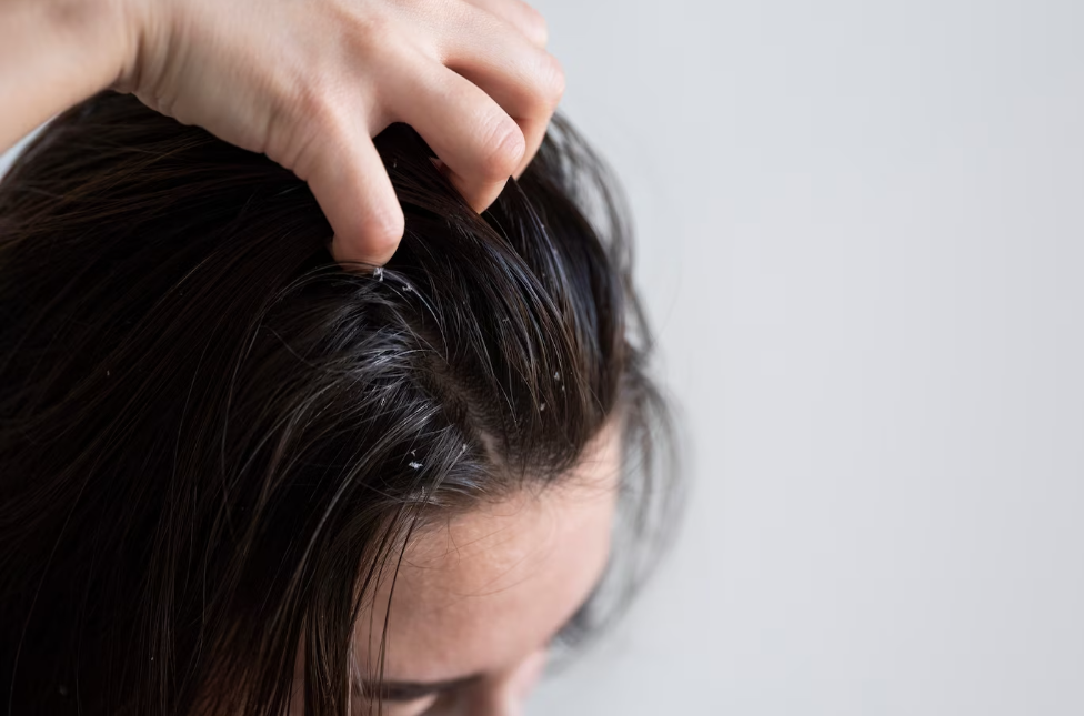 Oily scalp makes you feel uncomfortable and causes dandruff