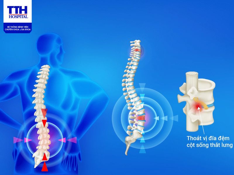 Thoát vị đĩa đệm ảnh hưởng đến sinh hoạt hằng ngày