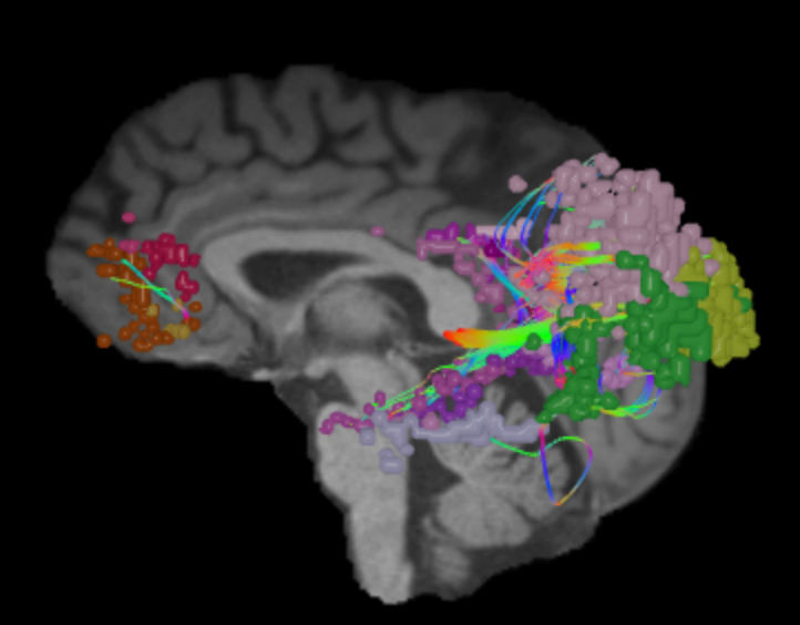 Ảnh minh họa Default Mode Network