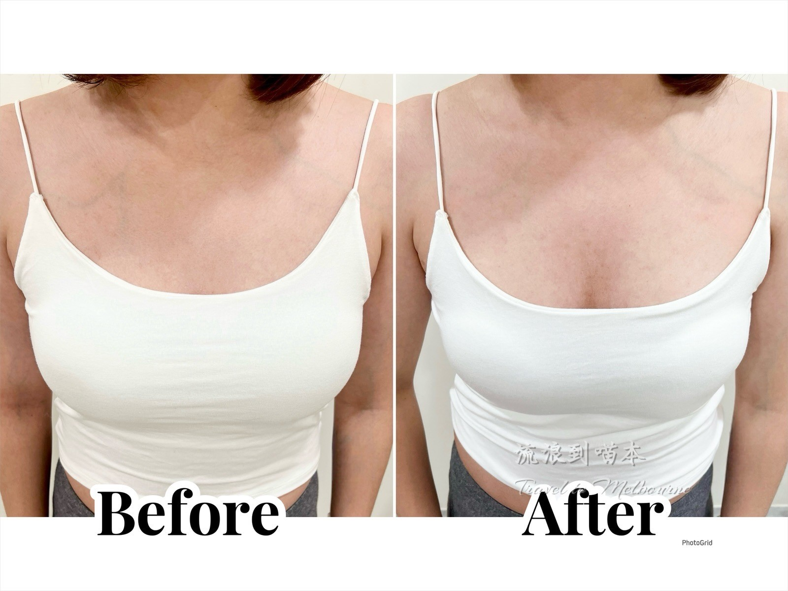 台中｜日式光學美胸－經驗分享，防止 胸部下垂、防止 胸部外擴