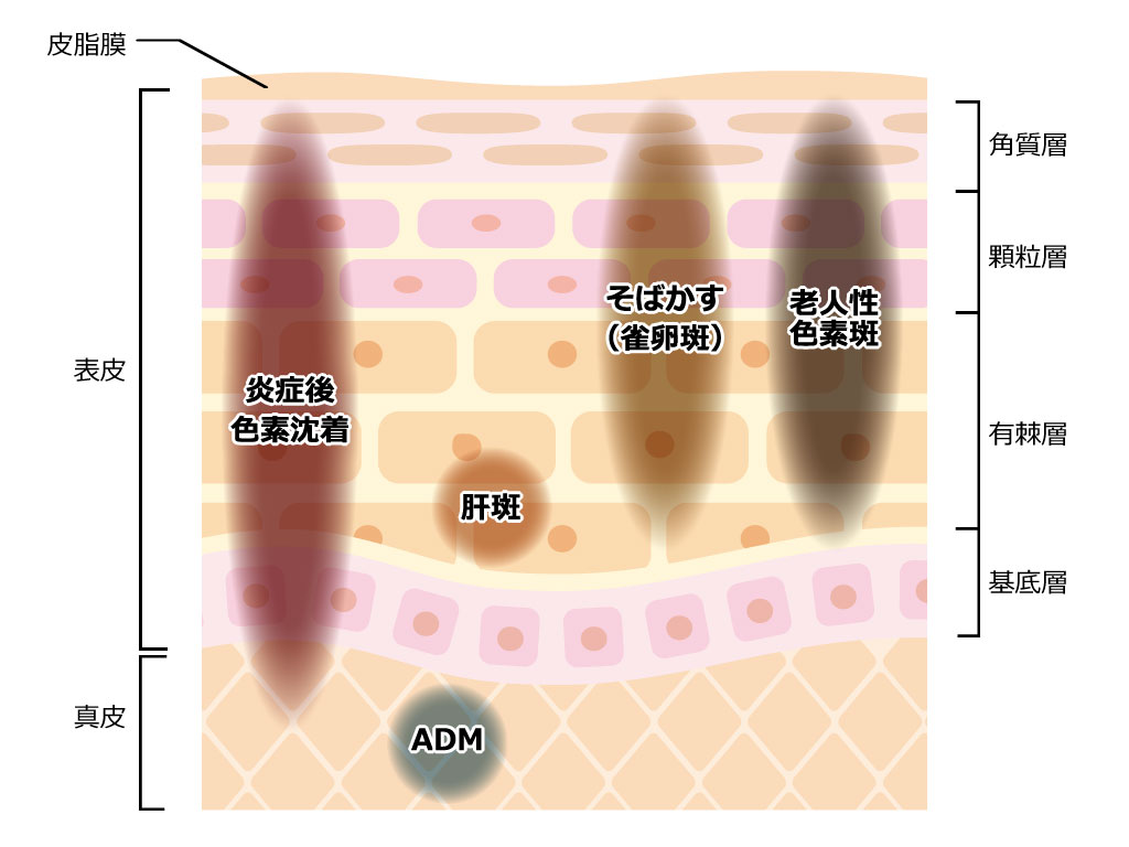 おもなシミの種類と現れる皮膚層