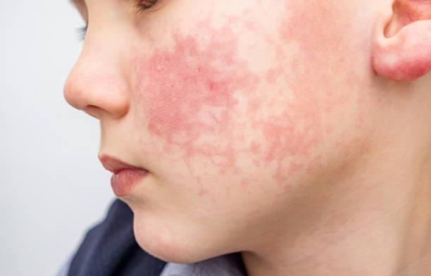 Boy with red cheeks- diathesis or allergy symptoms. Redness and peeling of the skin on the face. Boy with rosy red cheeks- diathesis or allergy symptoms. Redness and peeling of the skin on the face. eczema face stock pictures, royalty-free photos & images