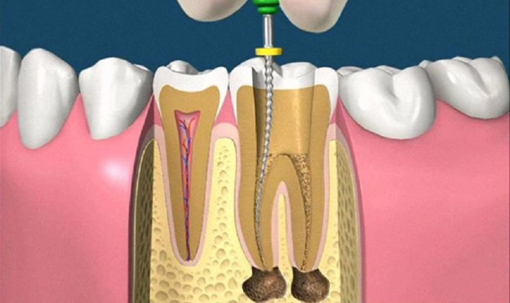 Tìm hiểu về lấy tủy răng và quy trình lấy tủy răng