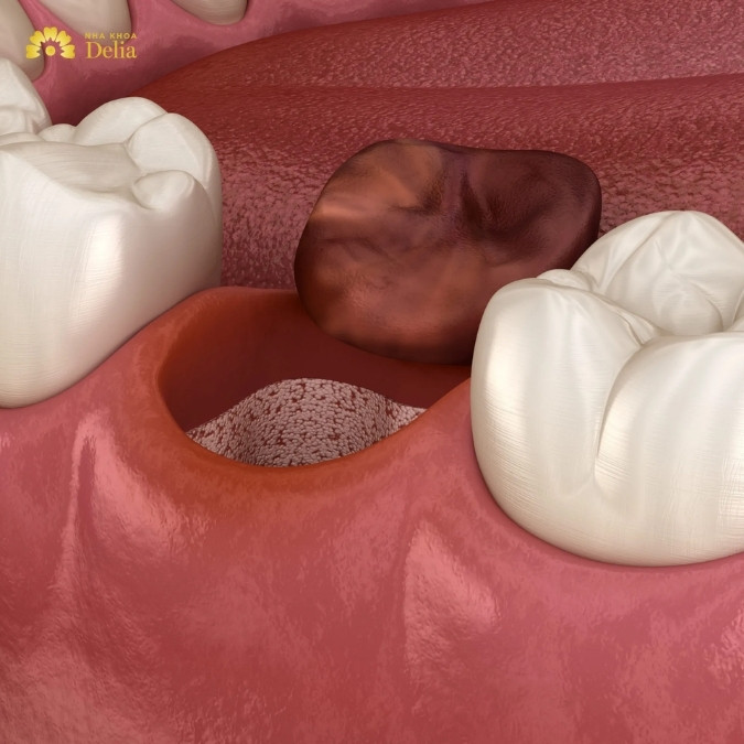 Viêm xương ổ răng là gì? Nguyên nhân khởi phát 