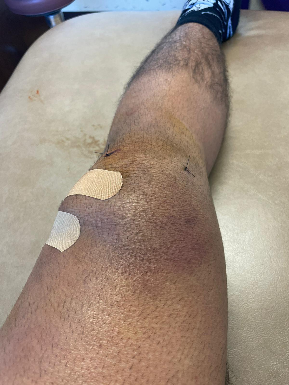 Knee after fluid was drained