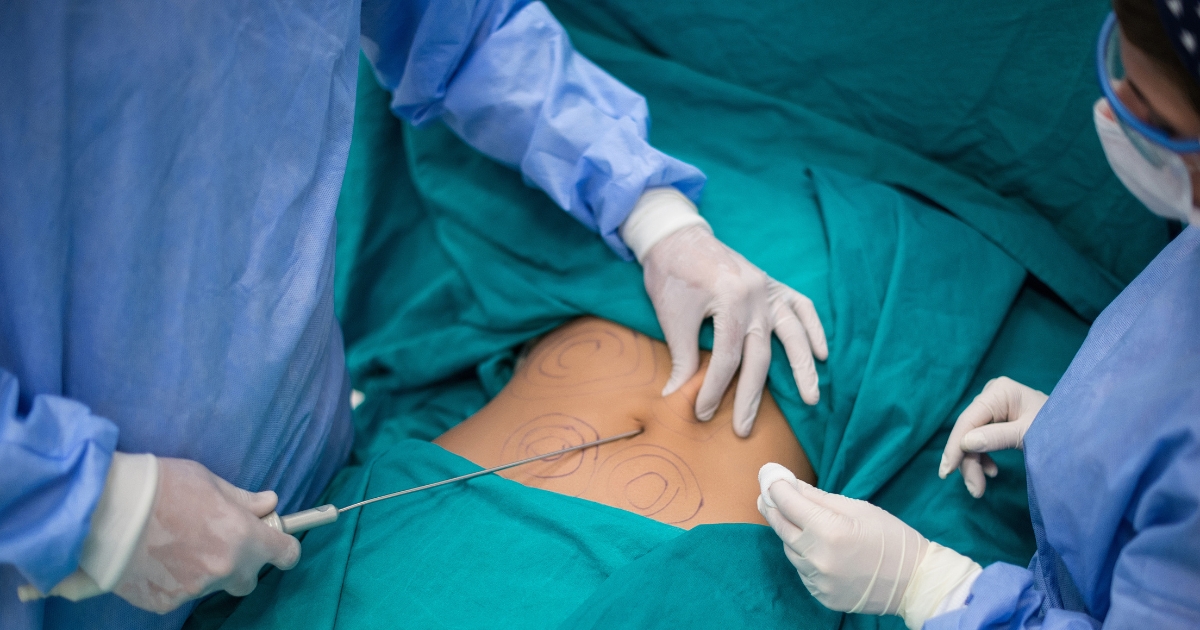 What Fat Does Liposuction Remove