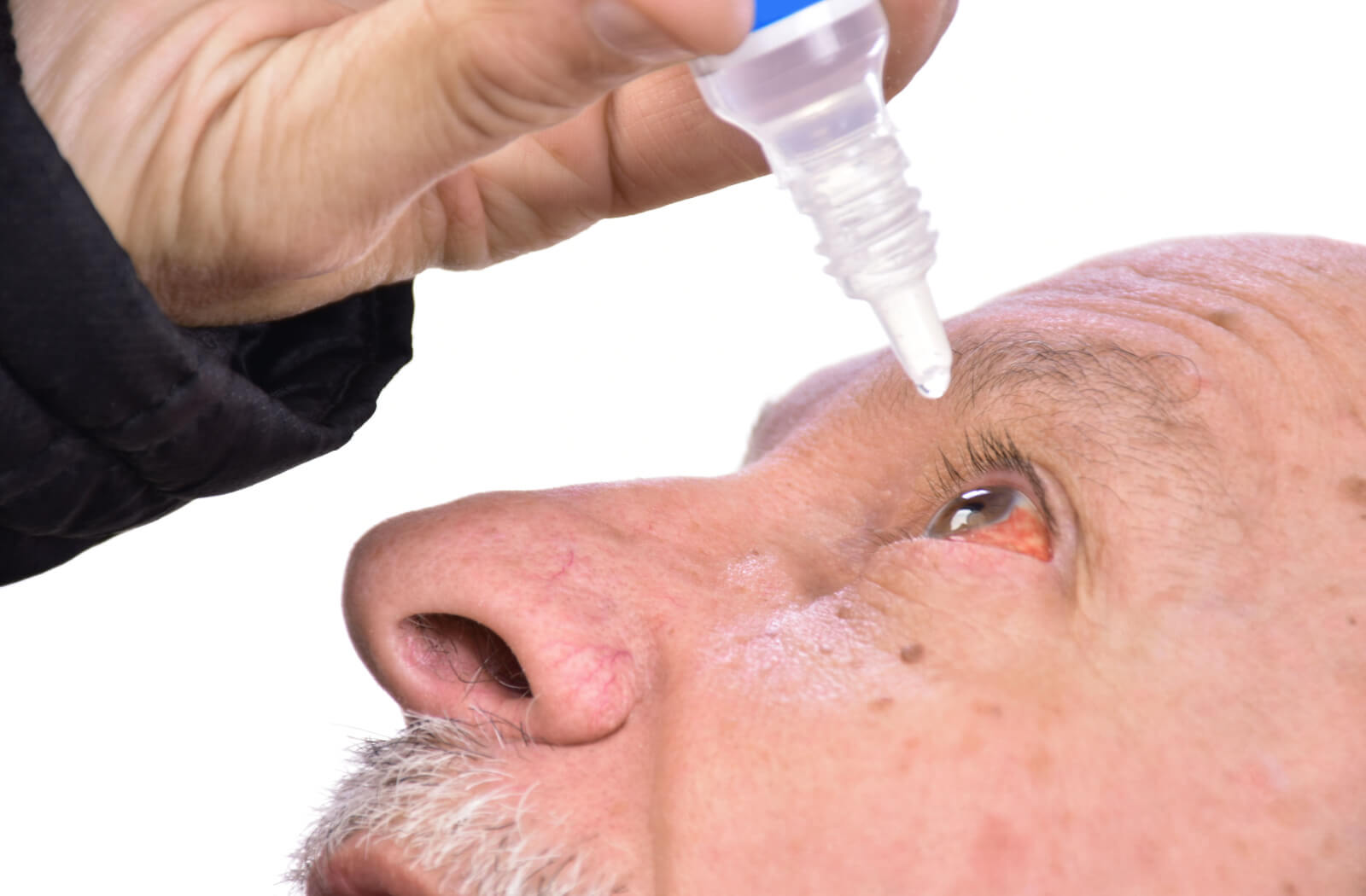 An elderly man is using eye drops to treat his dry eye. IPL is an effective therapy for relieving dry eye symptoms.