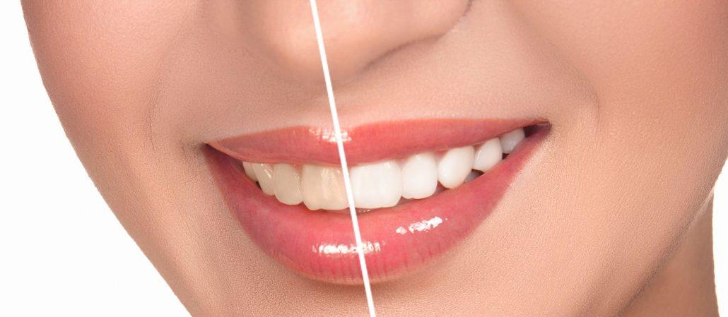 teeth whitening service in Newmarket