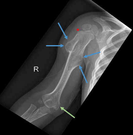X-ray showing bony spurts as typically seen on imaging for osteochondrosarcoma's