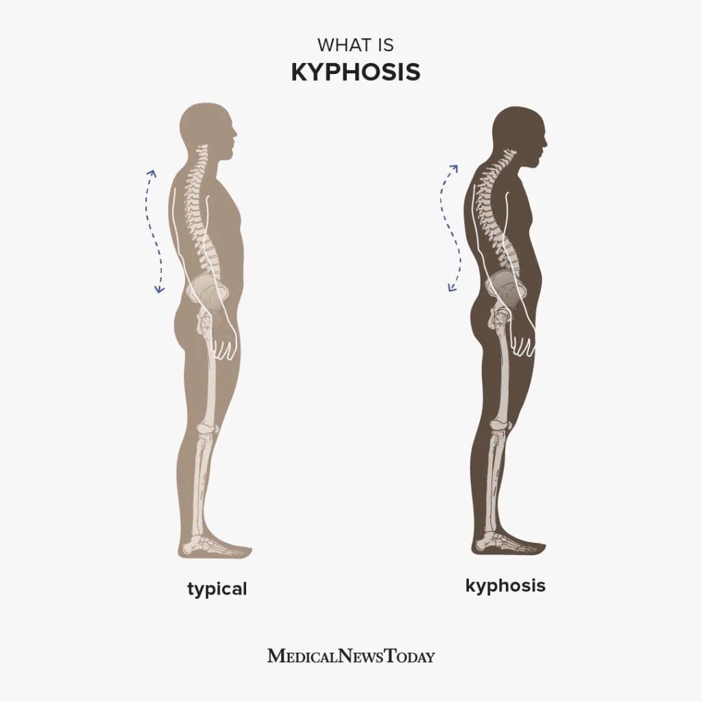 Problems Caused by Rounded Shoulders and How to Correct Them