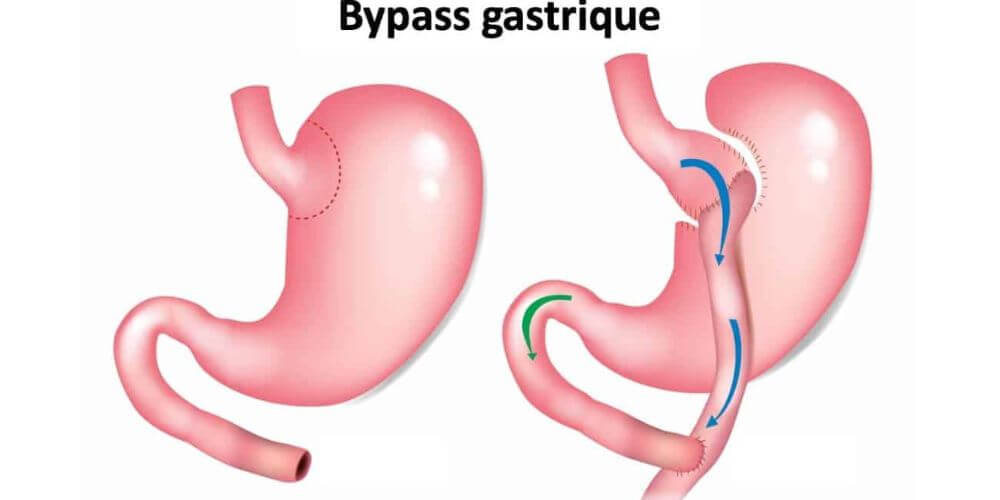 Bypass gastrique