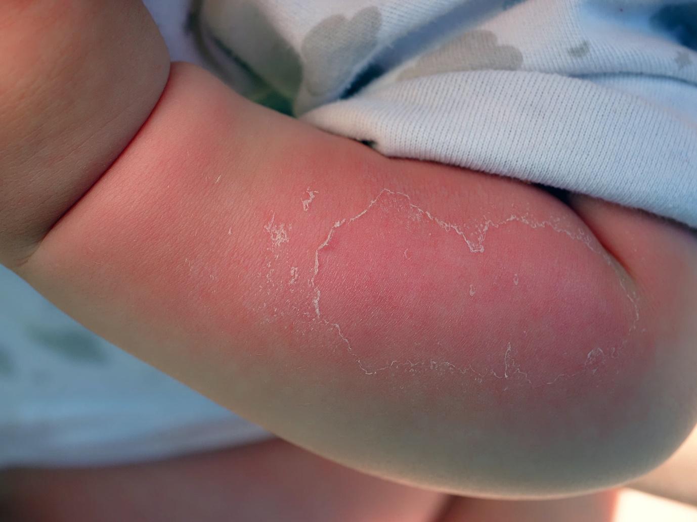 A baby's arm with a rash on itDescription automatically generated