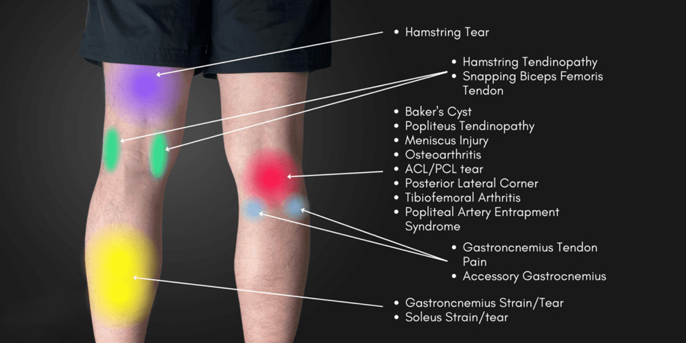 Knee Pain Location Chart Helps To Find Causes Of Pain And Diagnosis