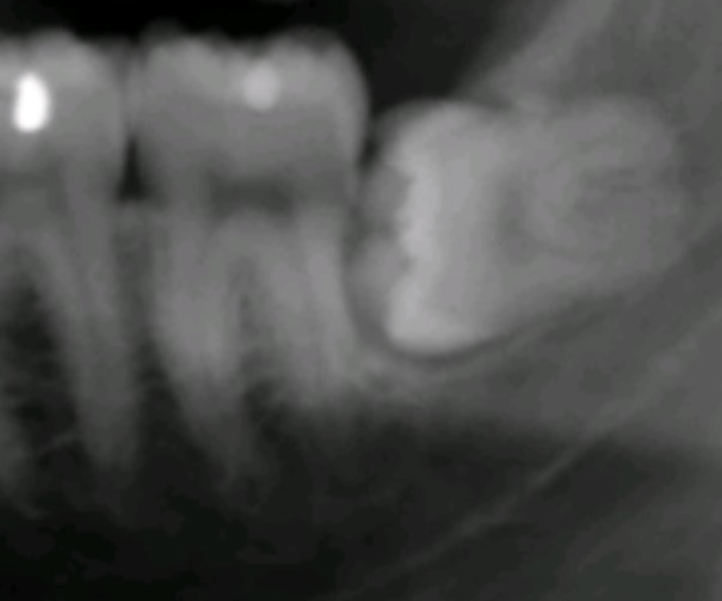 Wisdom tooth in poor alignement with the adjacent tooth
