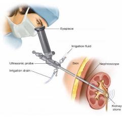 \\sghfslogix\UserData\sghd02800\Desktop\percutaneous-nephrolithotomy-2.jpg