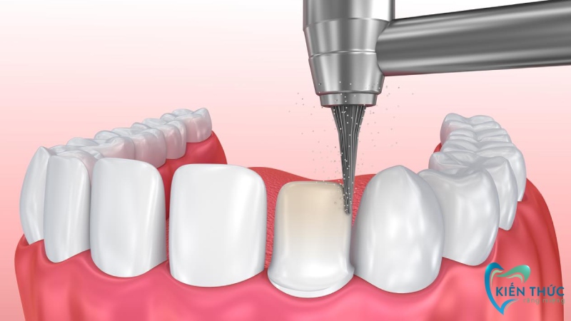 Quy trình bọc răng sứ được thực hiện như thế nào?