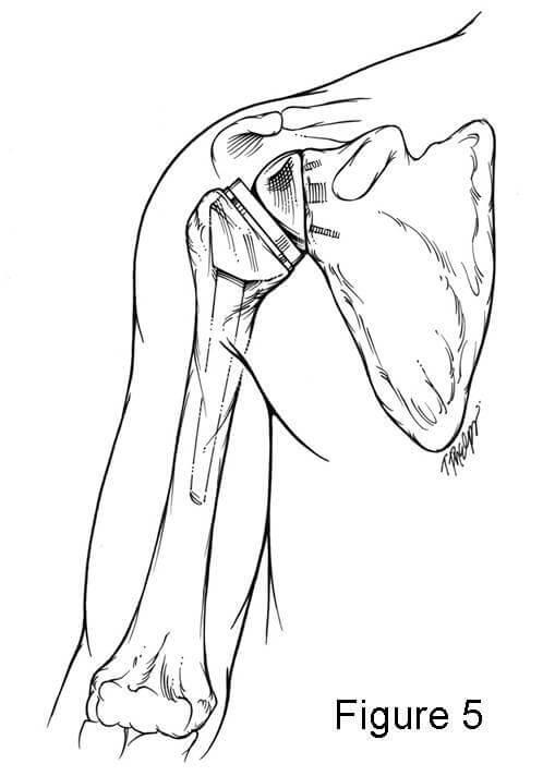 Diagram of shoulder movement after replacement