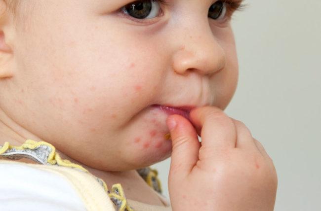 What To Know About Hand, Foot and Mouth Disease – Cleveland Clinic