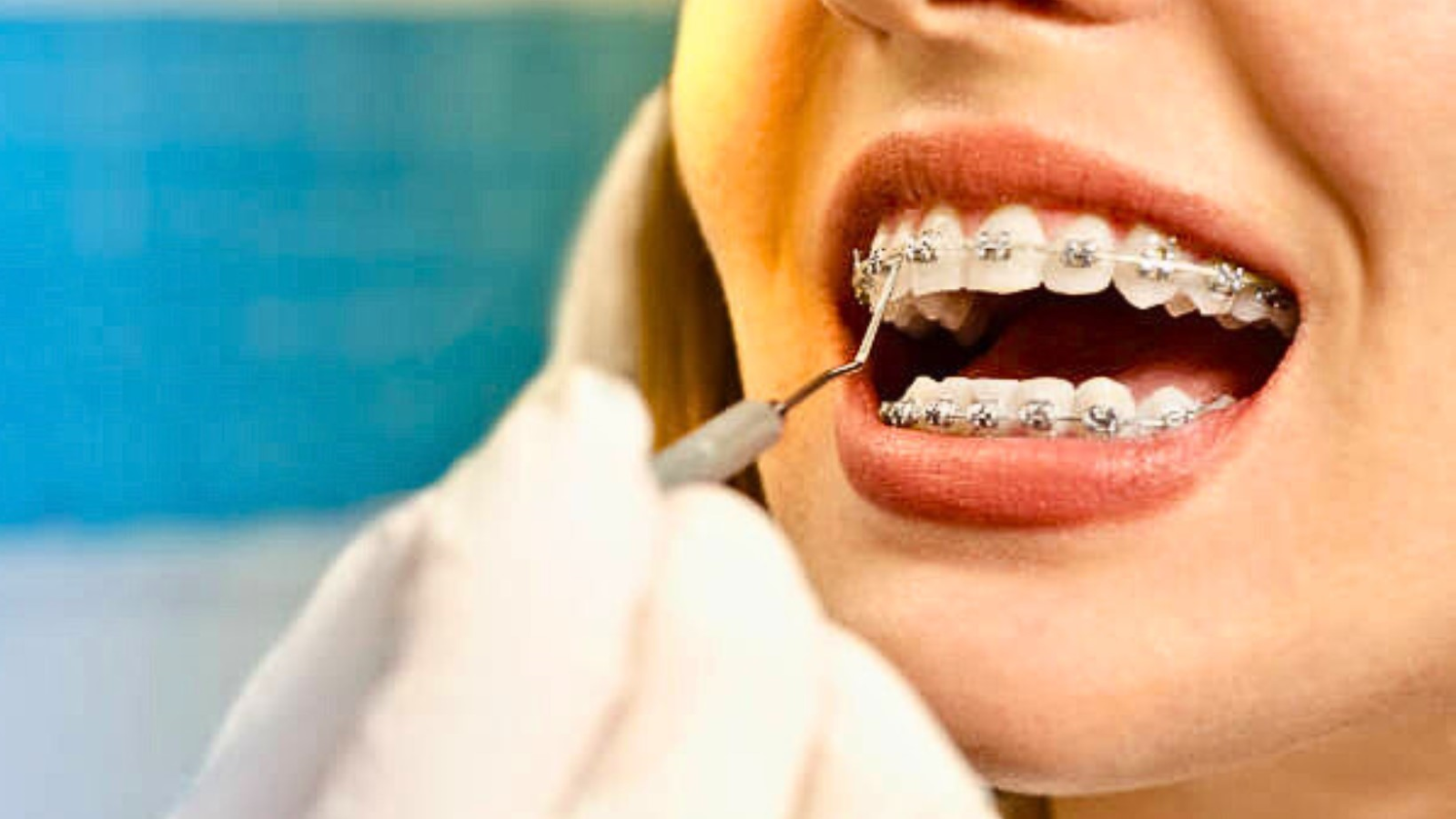 Transform Your Smile with Clear Braces for a Confident Look - Expert Orthodontic Solutions