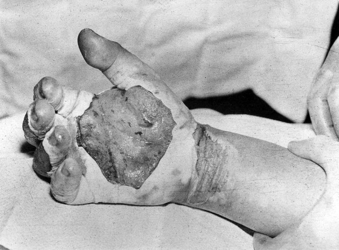 Harry Daghlian’s blistered hand after an accident with the demon core