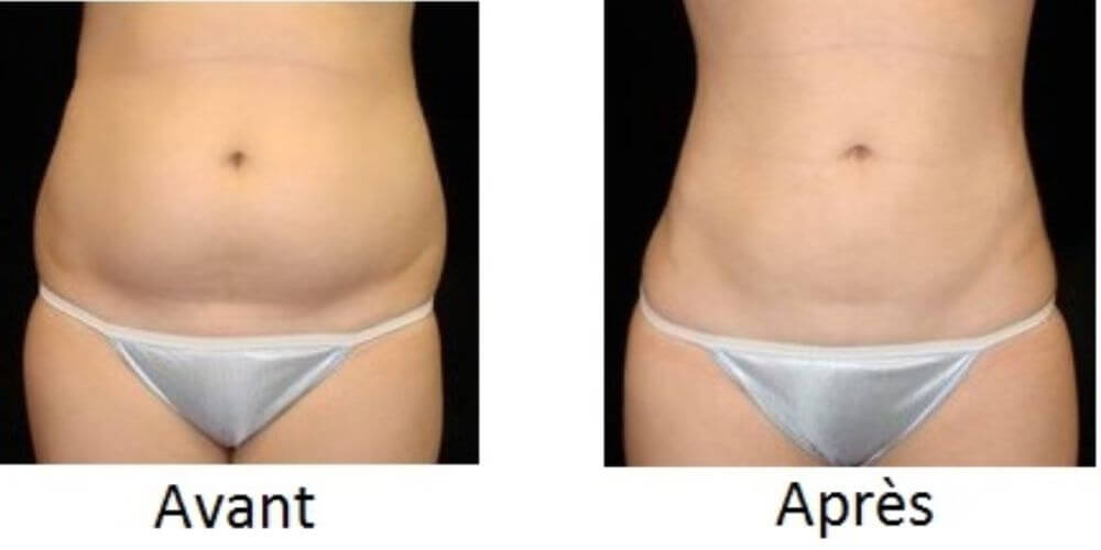 Avant et après chirurgie intime chez la femme
