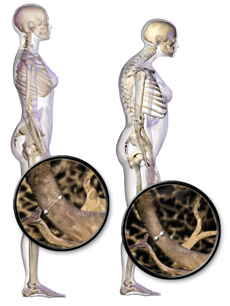 Idiopathic Juvenile Osteoporosis
