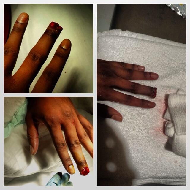 Rashad Johnson Severed Finger Picture