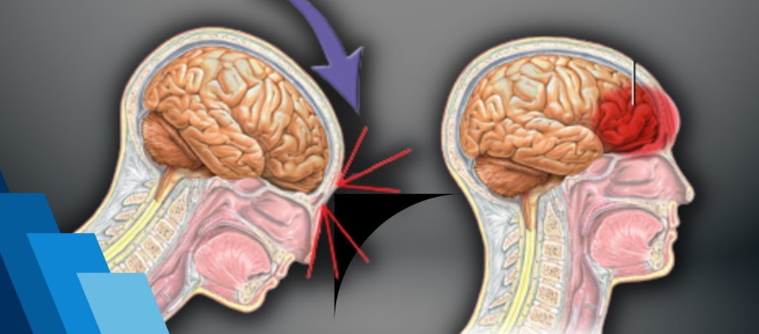 Diffuse Axonal Injury