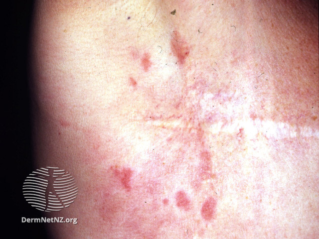 Cureus  Cutaneous Dermal Metastasis of Inflammatory Breast