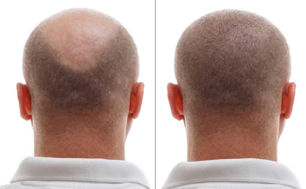 Hair transplant clinic Rubenhair revolutionary hair loss treatments with genetic tests