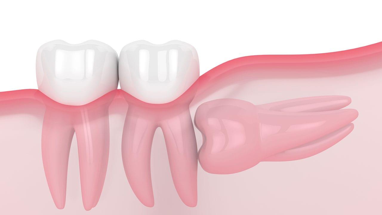 wisdom tooth removal in North York