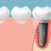 Ưu điểm của răng Implant so với cầu răng sứ