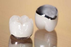 So với các loại răng sứ kim loại thường và titan thì răng sứ Chrome-Cobalt an toàn hơn