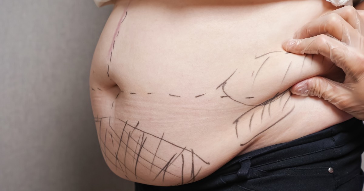 Liposuction Abdomen Before And After Liposuction