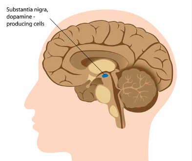 Can Head Trauma Increase the Risk of Parkinson's Disease?