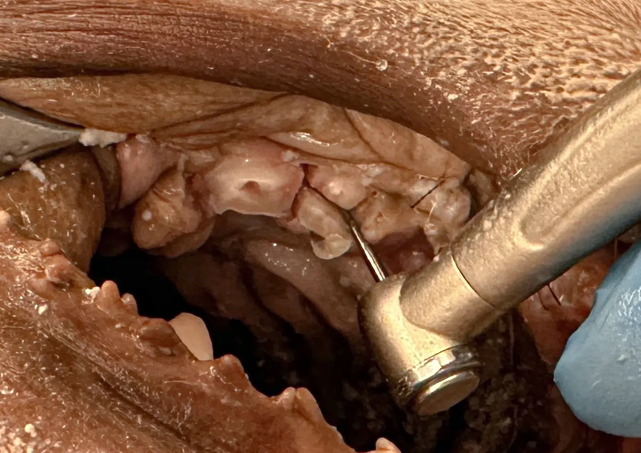 figure 3d: A #701 surgical bur used to create a trench around the maxillary canine root in a cadaver specimen
