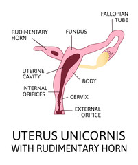 unicornuate uterus with rudimentary horn