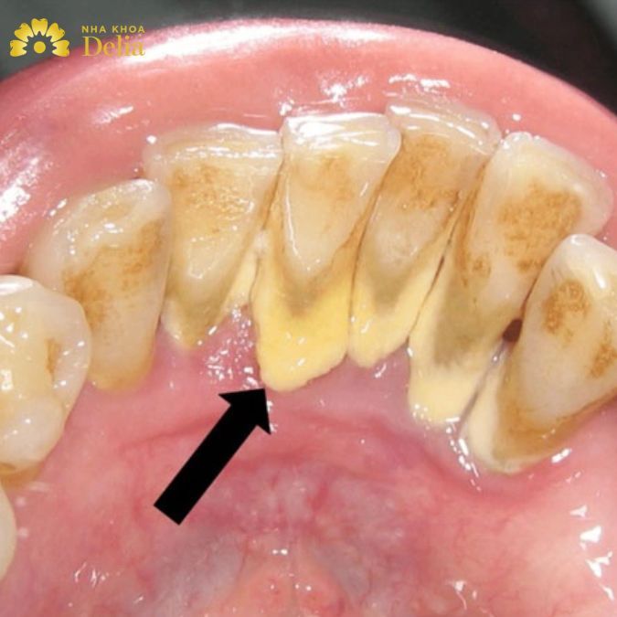 Cao răng dày tạo thành mảng bám tích tụ lâu ngày